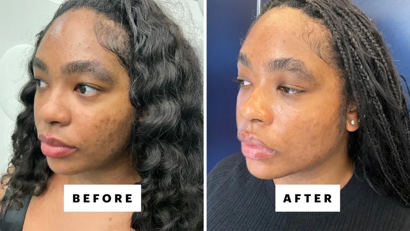 Laser Genesis Before and After results 