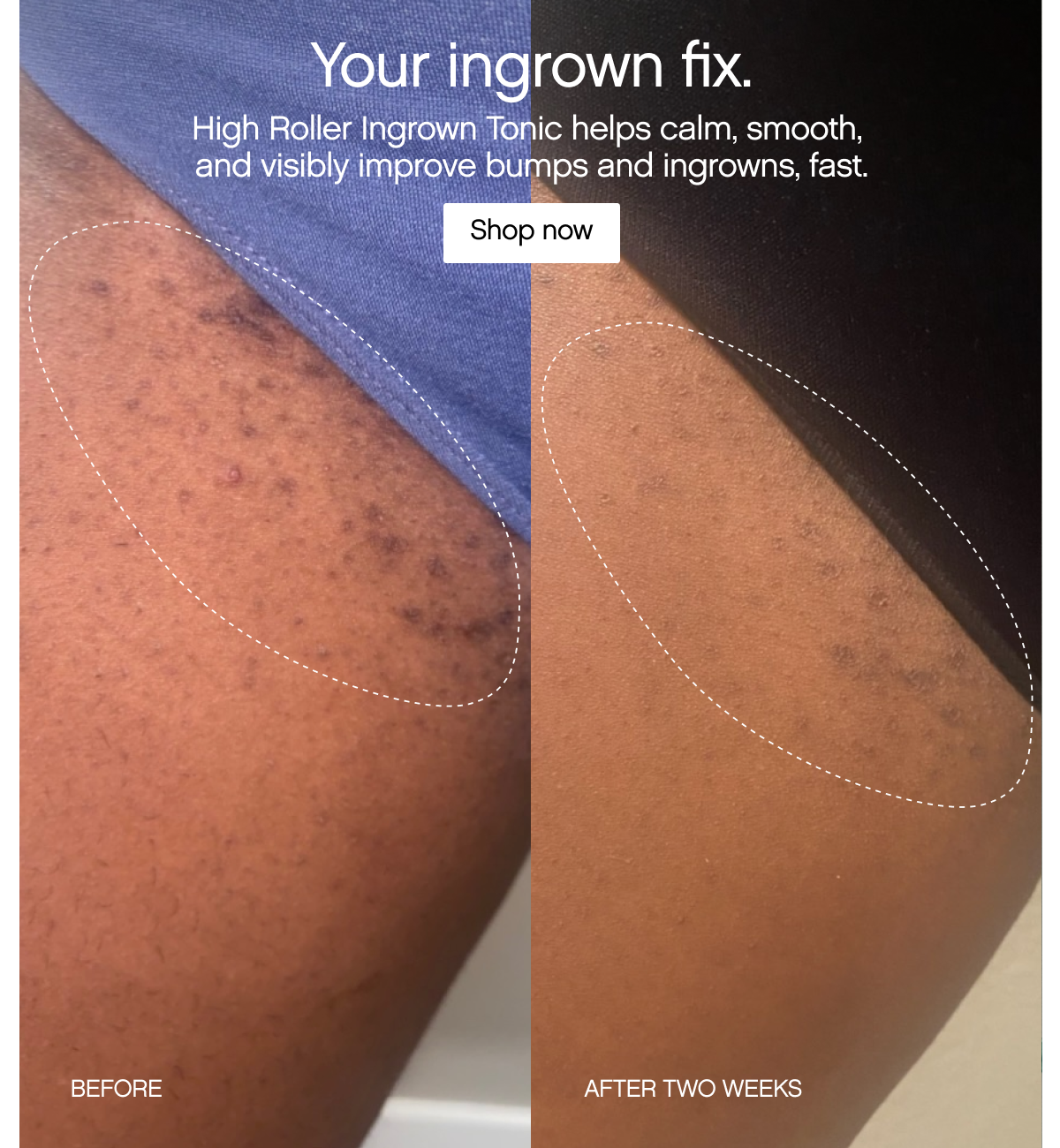 Your ingrown fix
