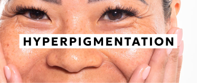 Hyperpigmentation