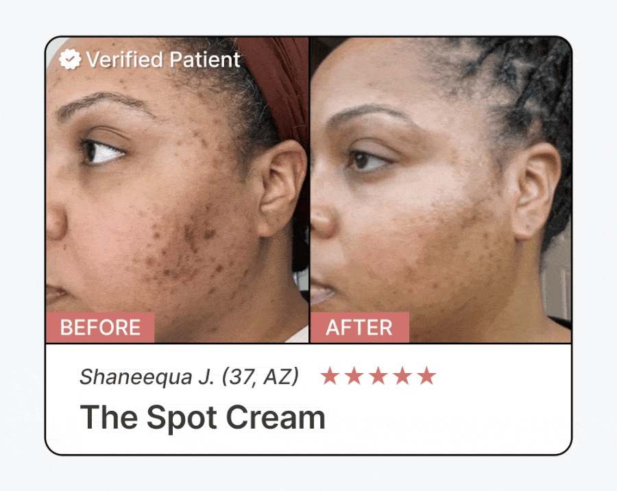 Hydroquinone Treatments