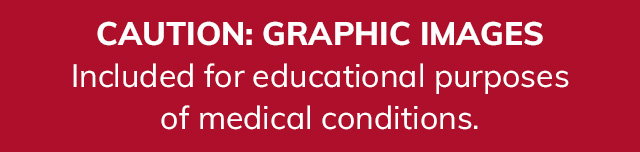 Caution: Graphic medical conditions While unpleasant, these images are included for educational purposes.