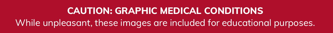 Caution: Graphic medical conditions While unpleasant, these images are included for educational purposes.