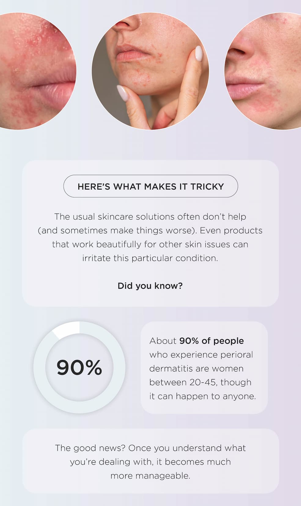 Perioral Dermatitis