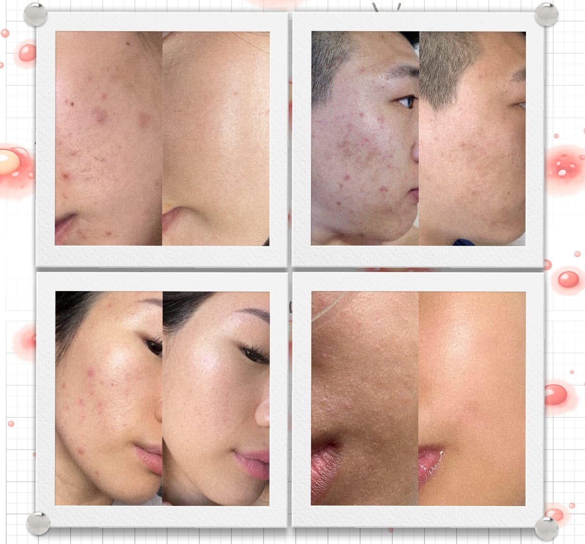 Four before and after skin comparison photos showing clearer skin results