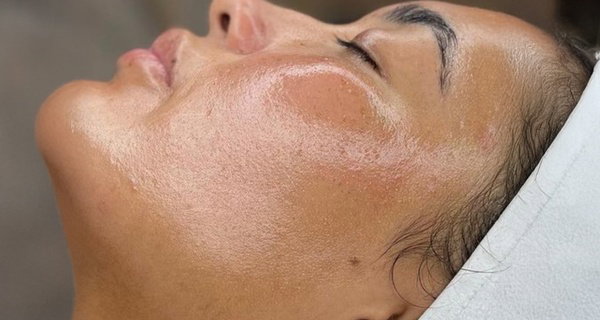 Up to 52% Off on HydraFacial at SKN2SKN Aesthetics