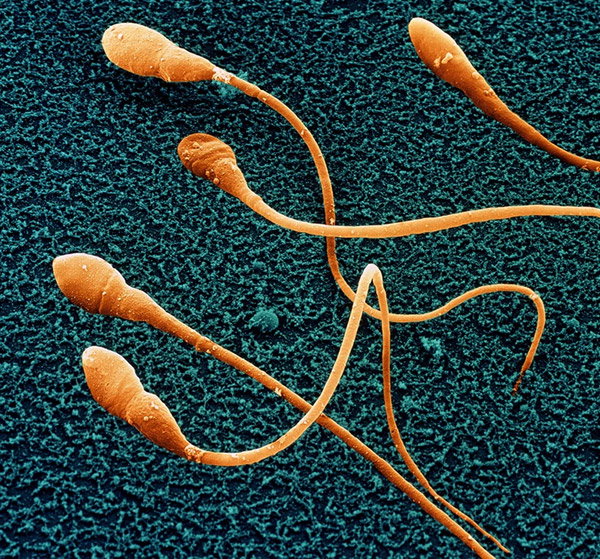 Coloured scanning electron micrograph of human sperm cells, coloured orange against a blue-green background.