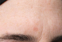Same brow area with even skin texture and color and less fine lines