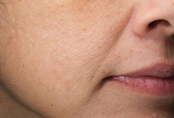 Same woman's cheek with brighter, even skin texture