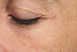 Woman's eye area with the appearance of fine lines and uneven skin texture