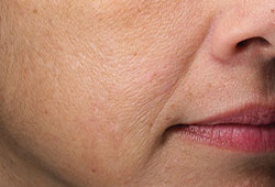 Woman's cheek with the appearance of uneven skin texture