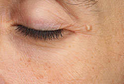 Reduction of wrinkles and roughness around the eye area