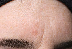 Persons brow area with uneven skin texture and color and deep lines