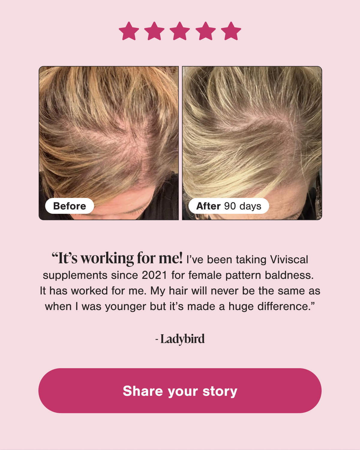 Share your story, Customer before and after photos showing visibly fuller-looking hair after 90 days with Viviscal. "It's working for me!" Read Ladybird's story and share your own.  