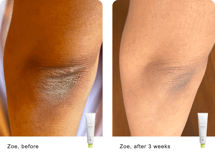 Zoe, before / Zoe, after 3 weeks