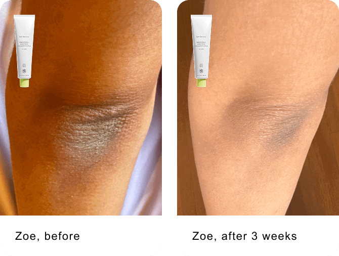 Zoe, before / Zoe, after 3 weeks