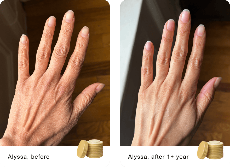 Alyssa, before / Alyssa, after 1+ year