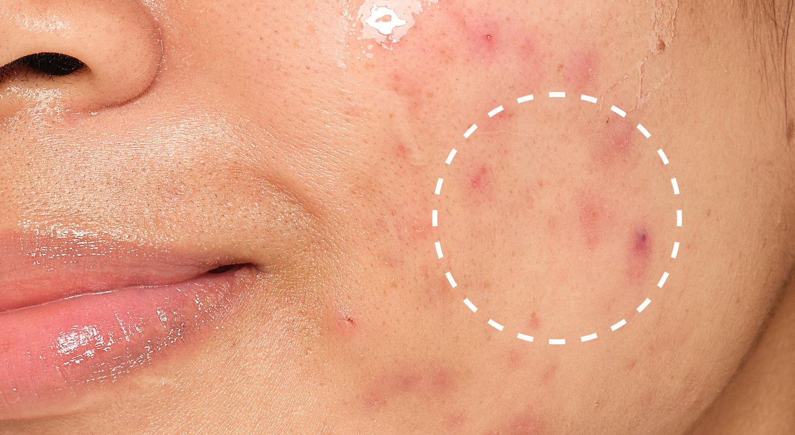 Target visible congestion with Niacinamide 10% + Zinc 1%.