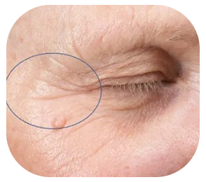 Woman's eye with deep crow's feet lines