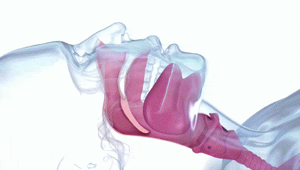 When air is forced through a smaller opening, it becomes turbulent and causes the surrounding soft tissues to vibrate, creating the sound we recognize as snoring. 