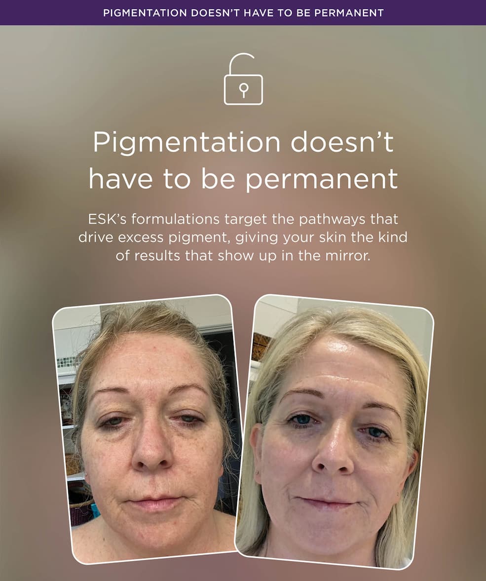 Pigmentation