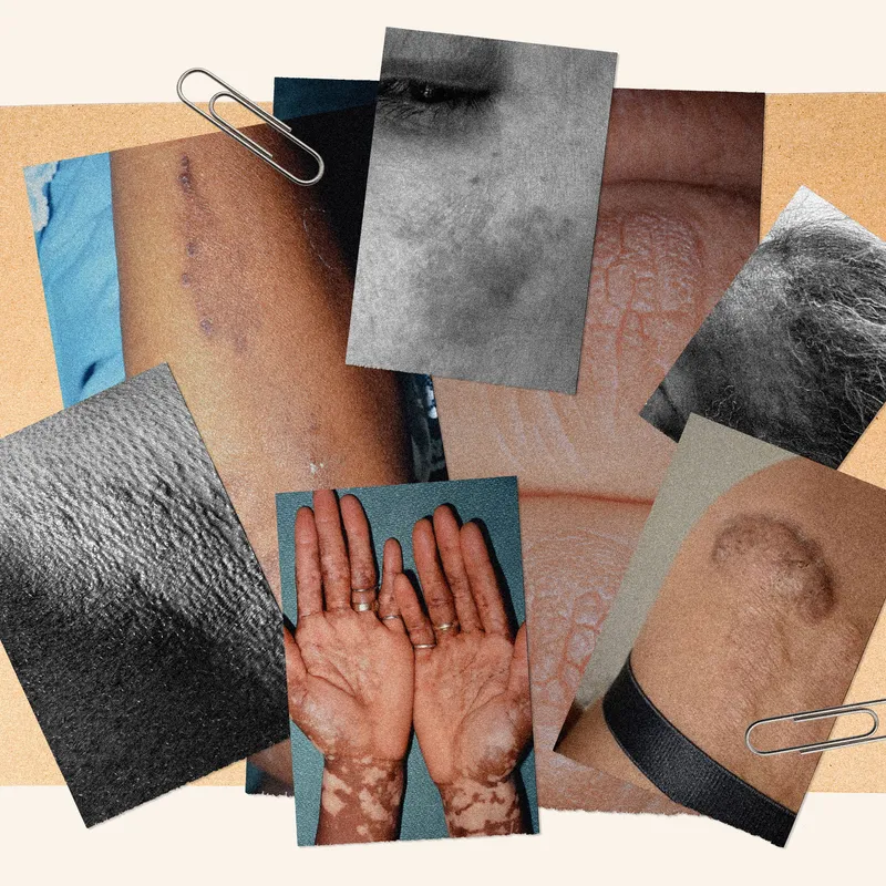 These Common Skin Conditions Can Look Different on Dark Skin