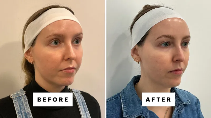 side by side photo of woman before and after xerf skin tightening treatment