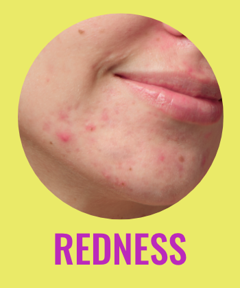 Redness