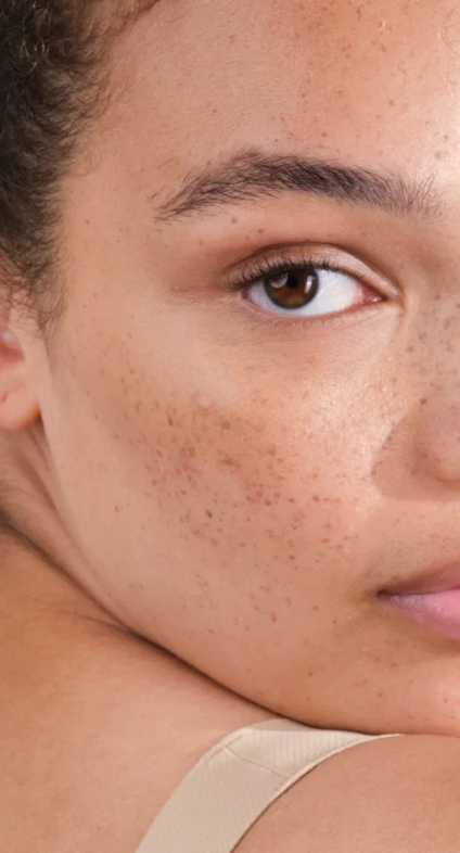 How to manage pigmentation