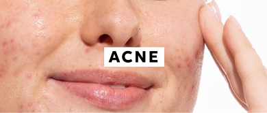 Acne
