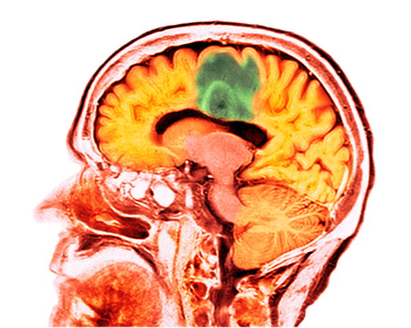 Coloured computed tomography scan of a section through the brain of an 84-year-old woman with glioblastoma.