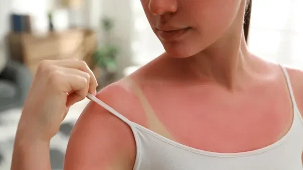 Voici les bons gestes pour soulager vite les coups de soleil (et éviter les erreurs)