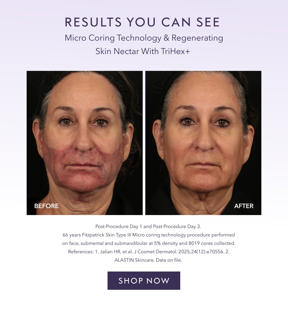 RESULTS YOU CAN
 SEE | Micro Coring Technology & Regenerating Skin Nectar With TriHex+ | Post-Procedure Day 1 and Post-Procedure Day 3. 66 years Fitzpatrick Skin Type Ill Micro coring technology procedure pertormed on face, submental and submandibular at 5% density and 8019 cores collected. References: 1. Jalian HR, et al. J Cosmet Dermatol. 2025;24(12):e70556. 2. ALASTIN Skincare. Data on file. SHOP NOW