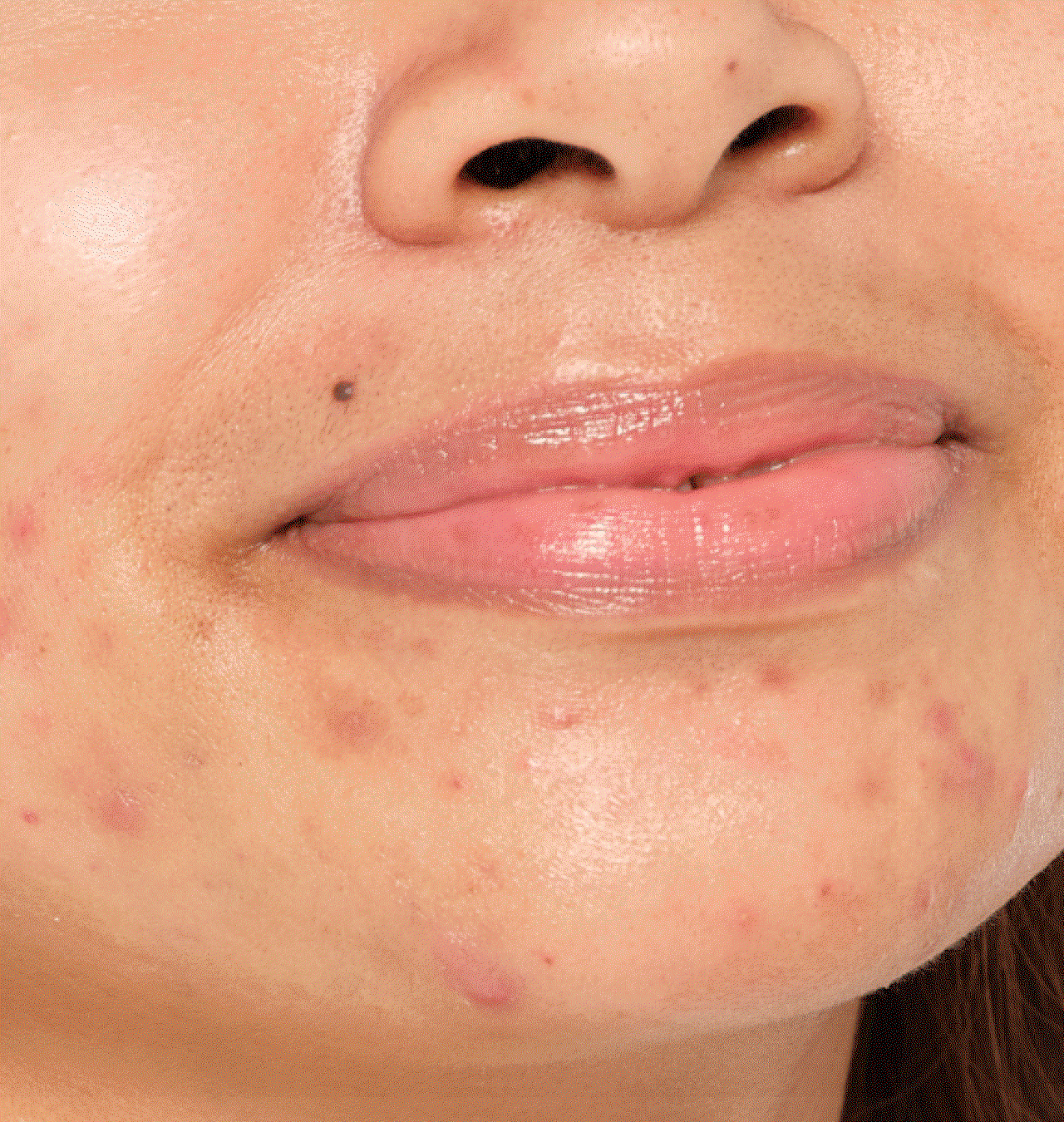 Understand acne with us.