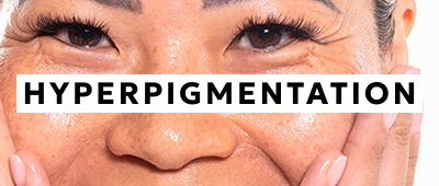 Hyperpigmentation