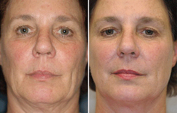 Shop 40% Off Liquid Facelift Wand