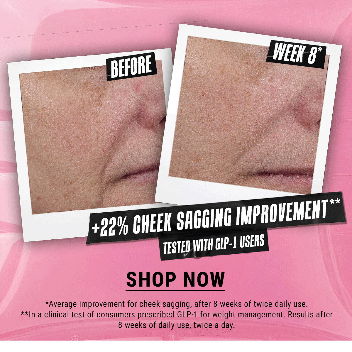 +22% Cheek sagging improvement**