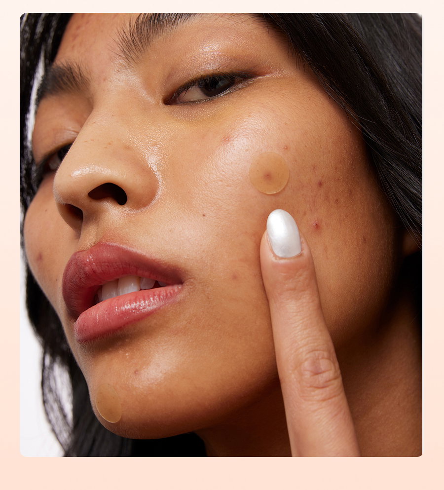 A young woman points to a Peace Out Acne Treatment Dot on her face
