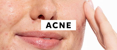 Acne