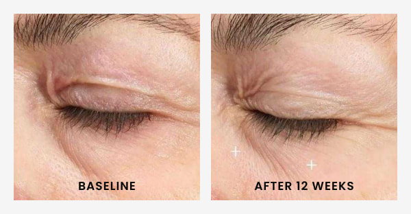 PCA Skin Hyaluronic Acid Microneedle Eye Patches Test Result