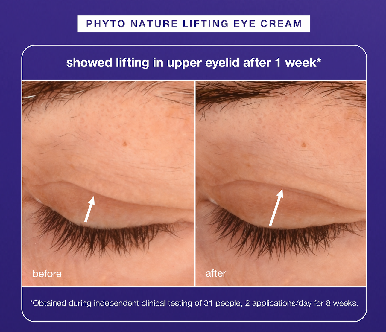 phyto nature lifting eye cream​  showed lifting in upper eyelid after 1 week* ​  ​  *Obtained during independent clinical testing of 31 people, 2 applications/day for 8 weeks.​  ​
