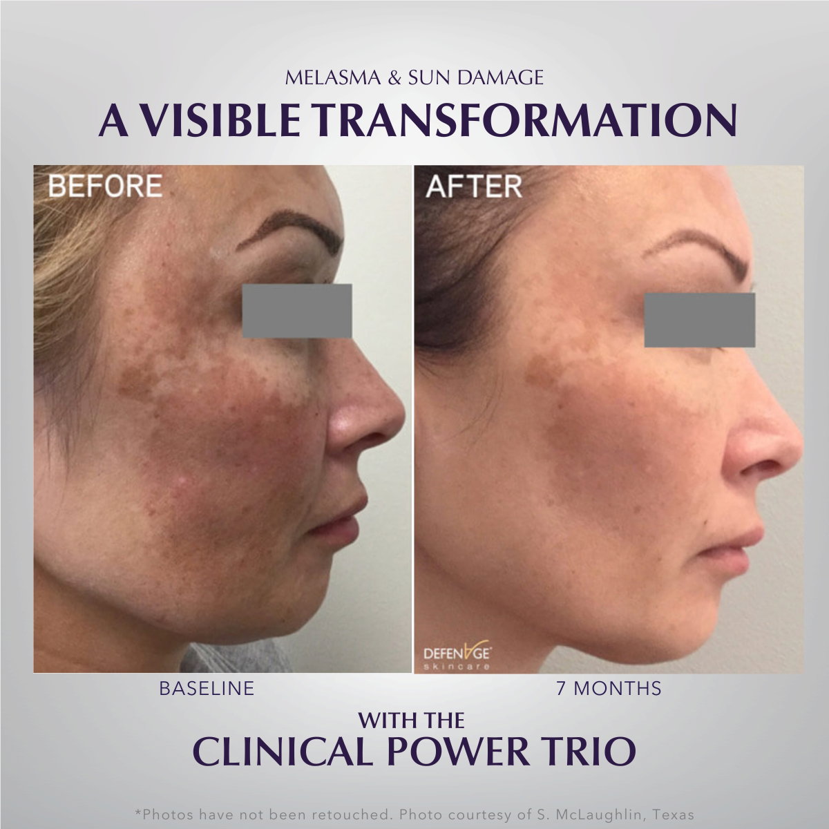 Melasma B/A