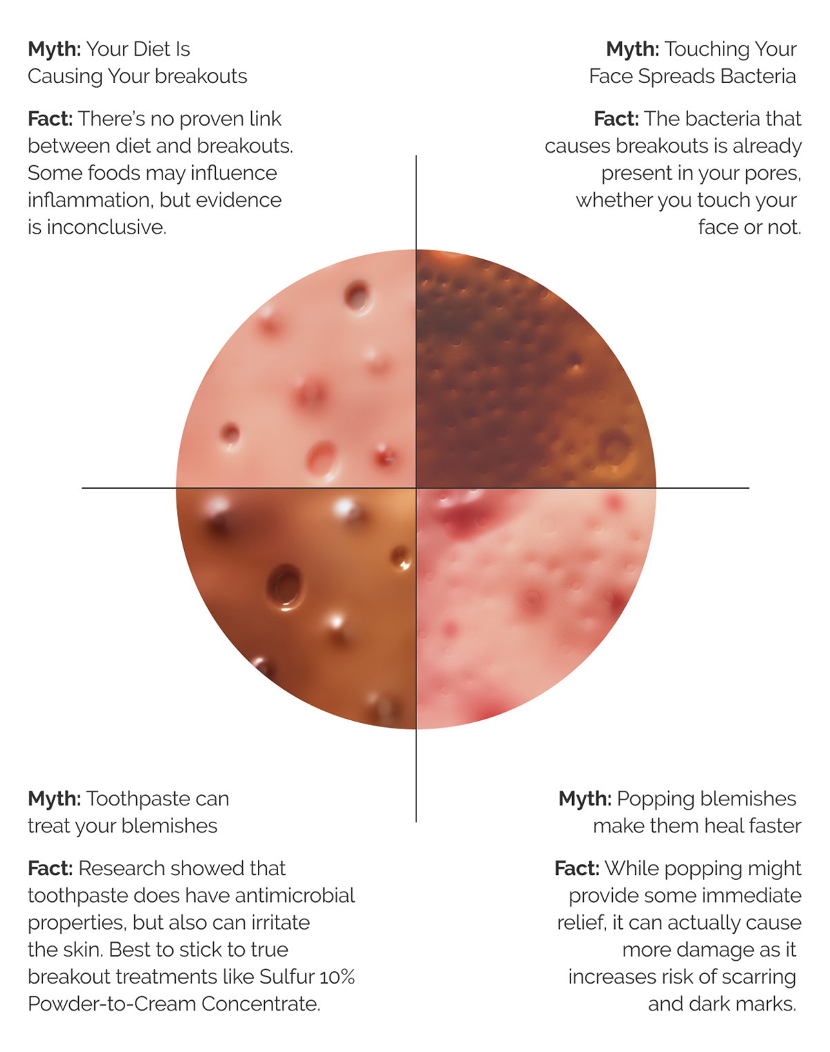 Learn more about the myths and facts about acne.
