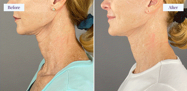 Shop 40% Off Neck Chin Jawline Sculpting Wand Duo Sets