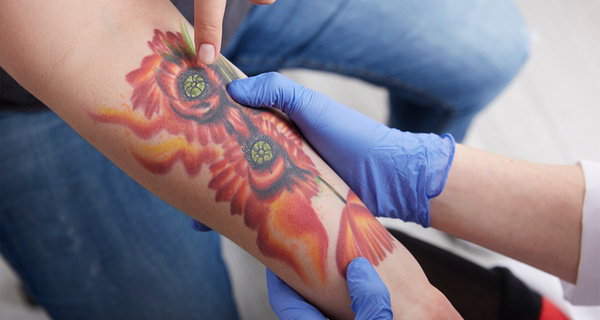 Zap Away Regretful Tattoos with PiQo4 Laser Tattoo-Removal!