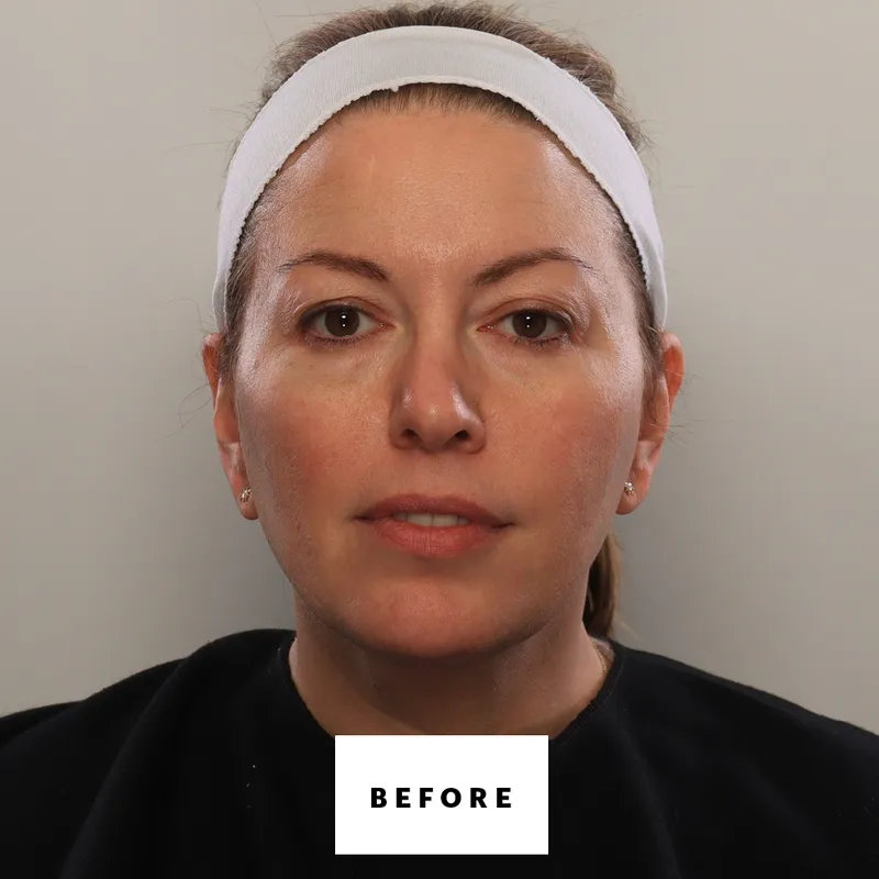 Can You Fake a Blepharoplasty? I Gave It My Best Shot.
