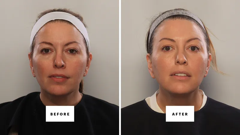 a woman in her 40s before and after 8 treatments to lift her eyelids without a blepharoplasty