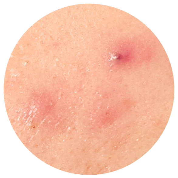 Learn more about angry red spots.