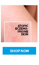 Atopic Eczema-Prone Skin