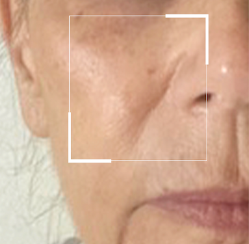 here's what it looks like before Ultra-Fill Marionette Line Treatment! Learn more at citybeauty.com. 💙