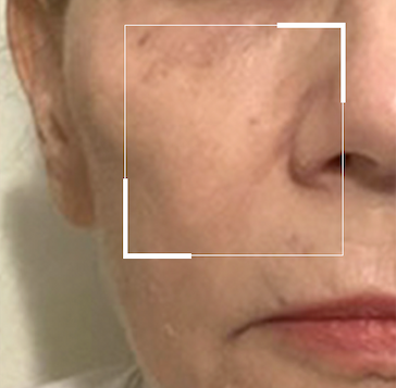 here's what it looks like after Ultra-Fill Marionette Line Treatment! Learn more at citybeauty.com 💙